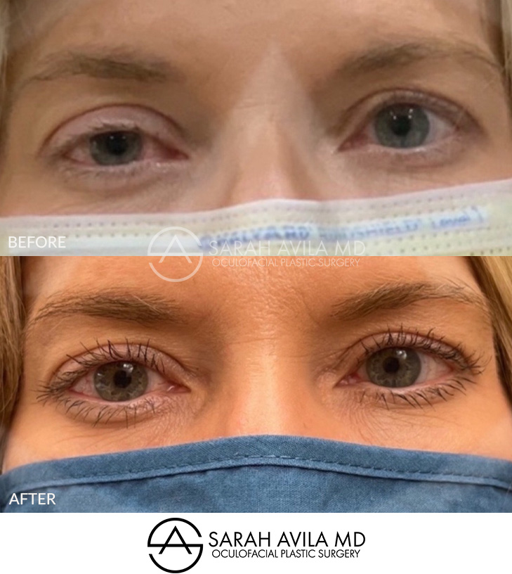Eyelid Ptosis Patient 13