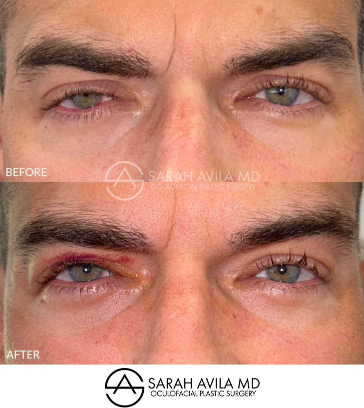 Eyelid Ptosis Patient 14