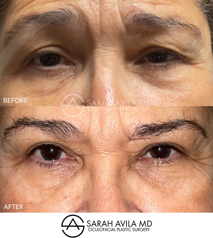 Eyelid Ptosis Patient 15