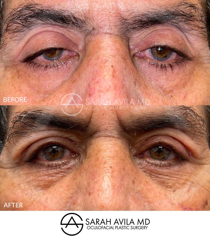 Eyelid Ptosis Patient 18