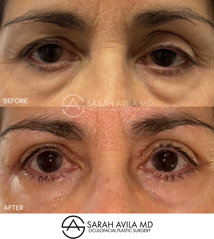 Eyelid Ptosis Patient 19