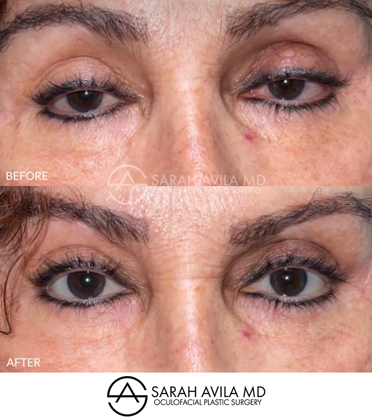 Eyelid Ptosis Patient 2