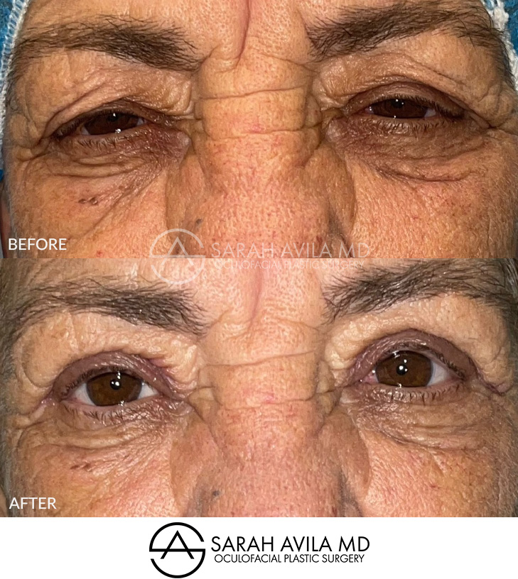 Eyelid Ptosis Patient 20