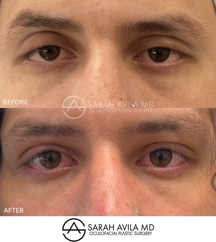 Eyelid Ptosis Patient 3