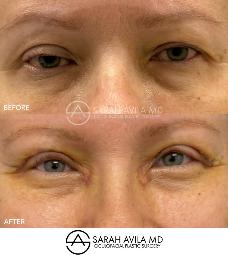 Eyelid Ptosis Patient 4