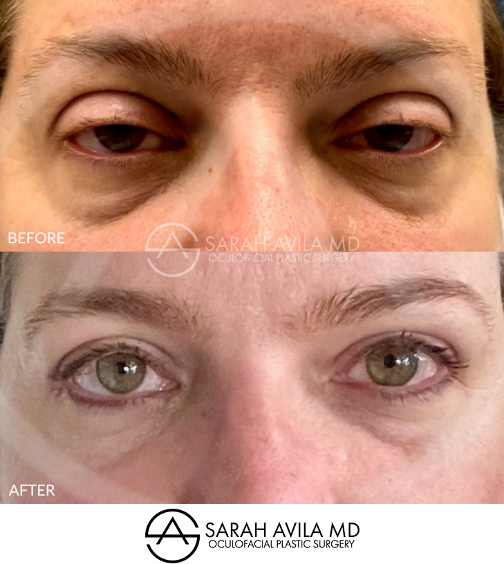 Eyelid Ptosis Patient 5