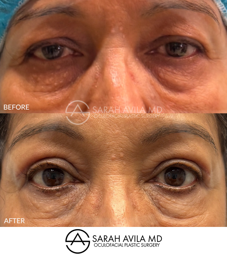 Eyelid Ptosis Patient 6