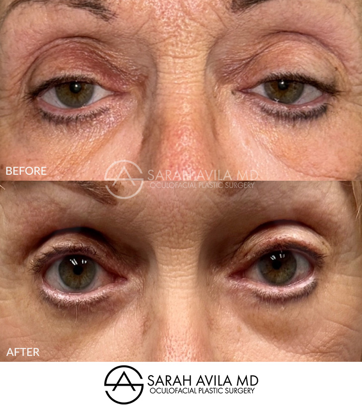 Eyelid Ptosis Patient 7