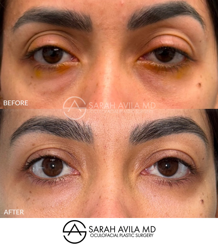 Eyelid Ptosis Patient 8