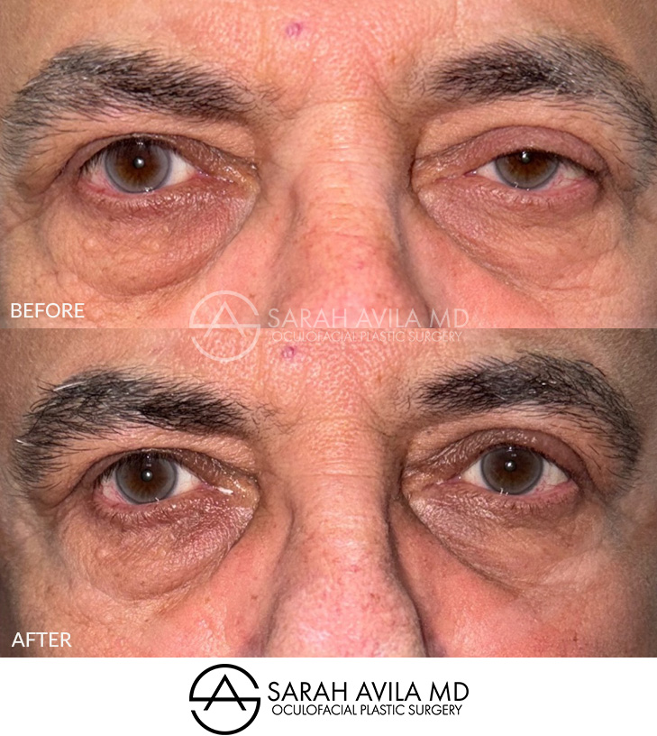 Eyelid Ptosis Patient 9