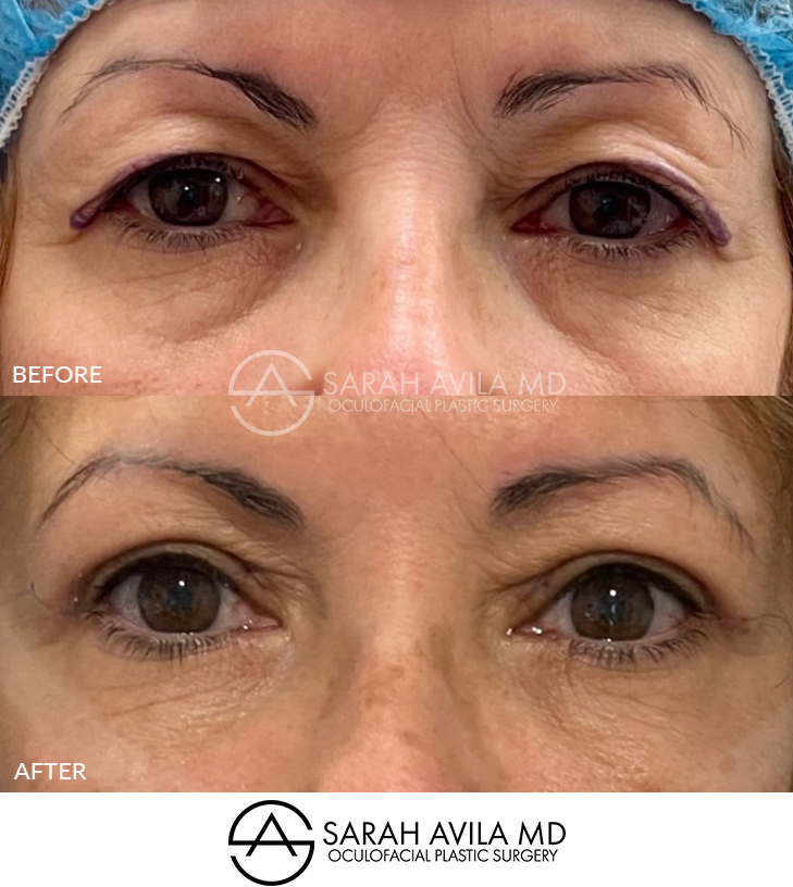 Upper Blepharoplasty Patient 10
