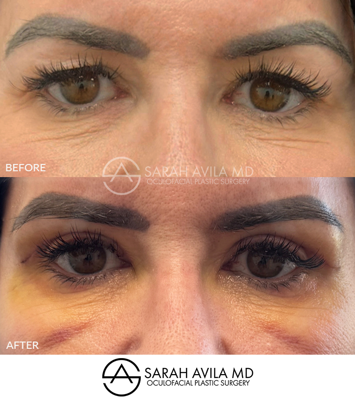 Upper Blepharoplasty Patient 11