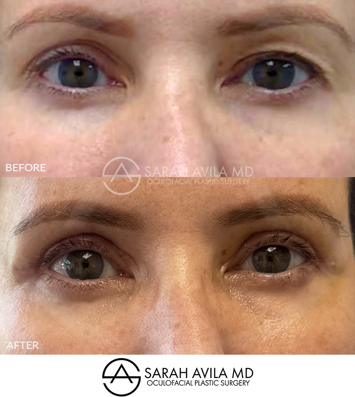 Upper Blepharoplasty Patient 12