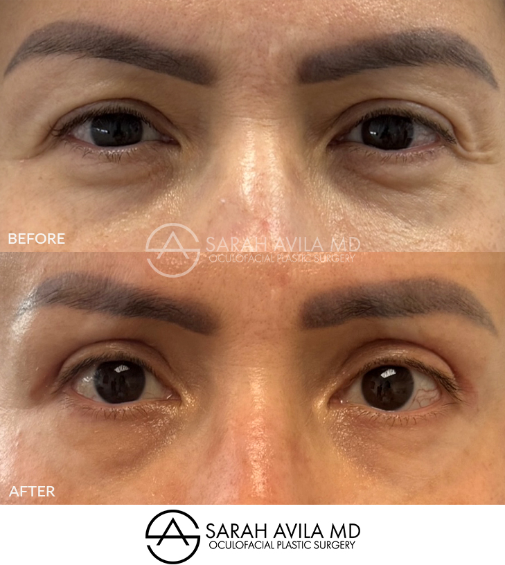 Upper Blepharoplasty Patient 13