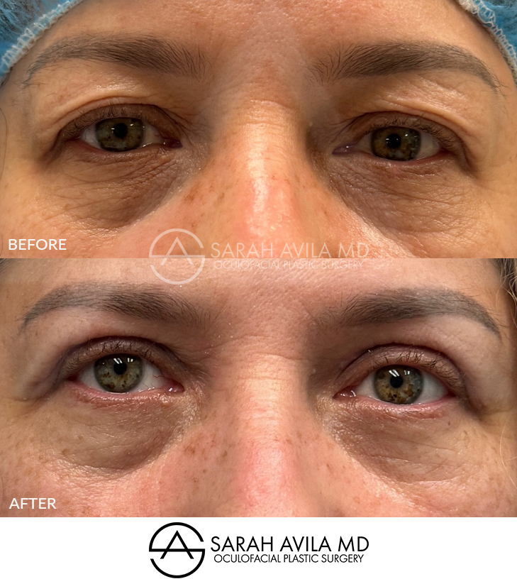 Upper Blepharoplasty Patient 14