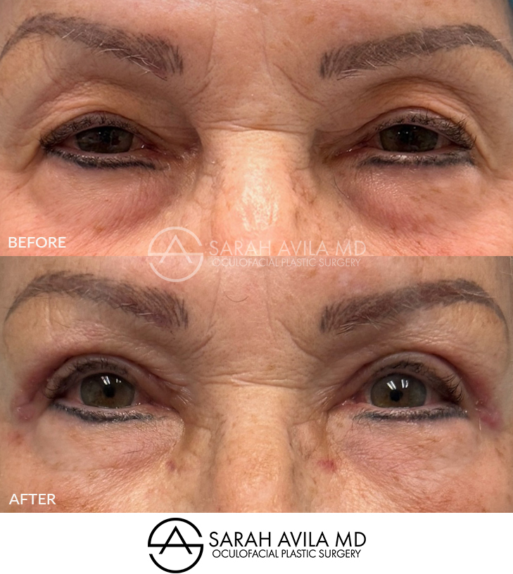 Upper Blepharoplasty Patient 15