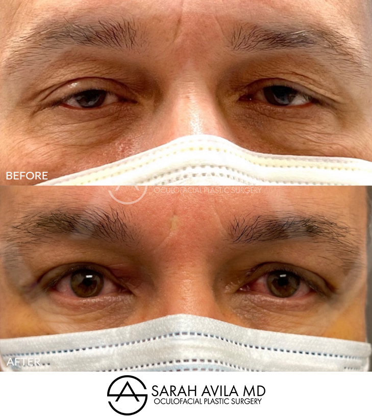Upper Blepharoplasty Patient 16
