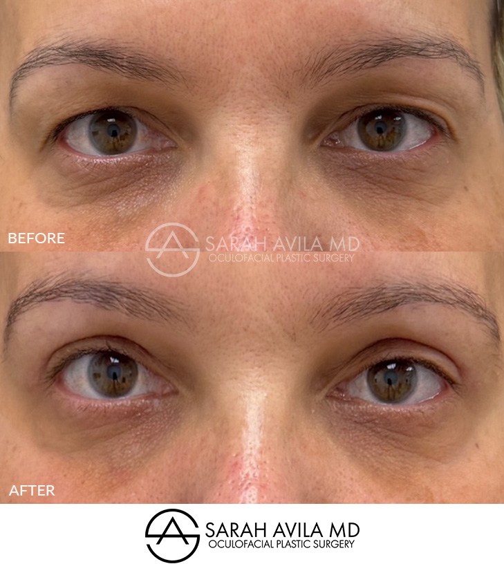 Upper Blepharoplasty Patient 17