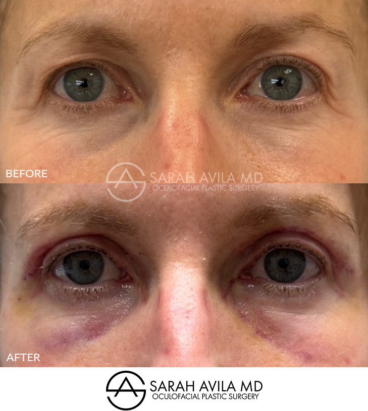 Upper Blepharoplasty Patient 18