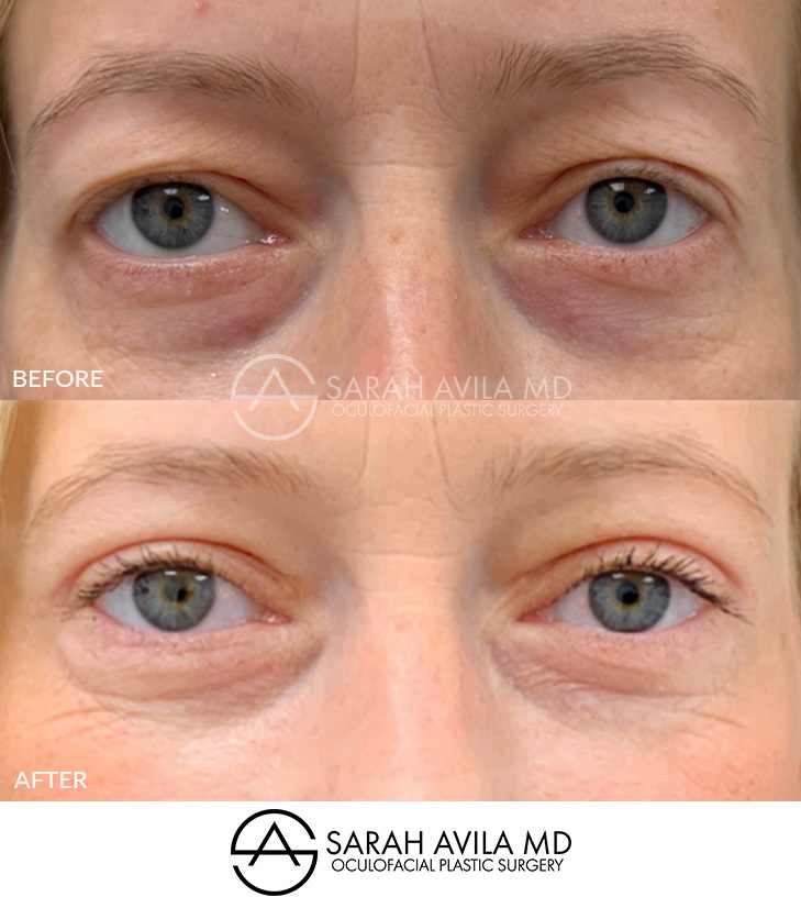 Upper Blepharoplasty Patient 19