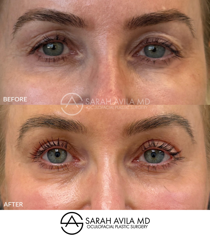 Upper Blepharoplasty Patient 1