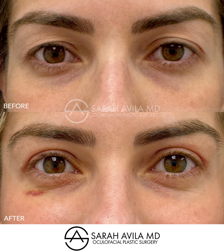 Upper Blepharoplasty Patient 2