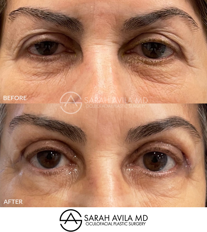 Upper Blepharoplasty Patient 3