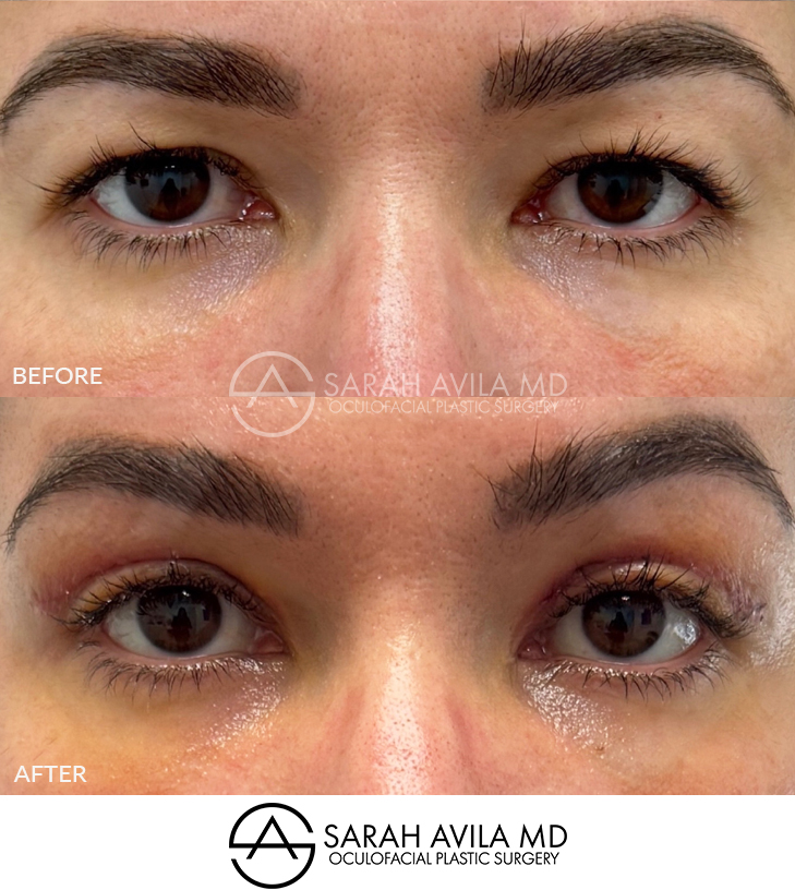 Upper Blepharoplasty Patient 4