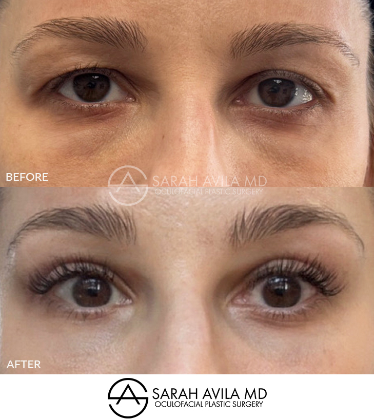 Upper Blepharoplasty Patient 5