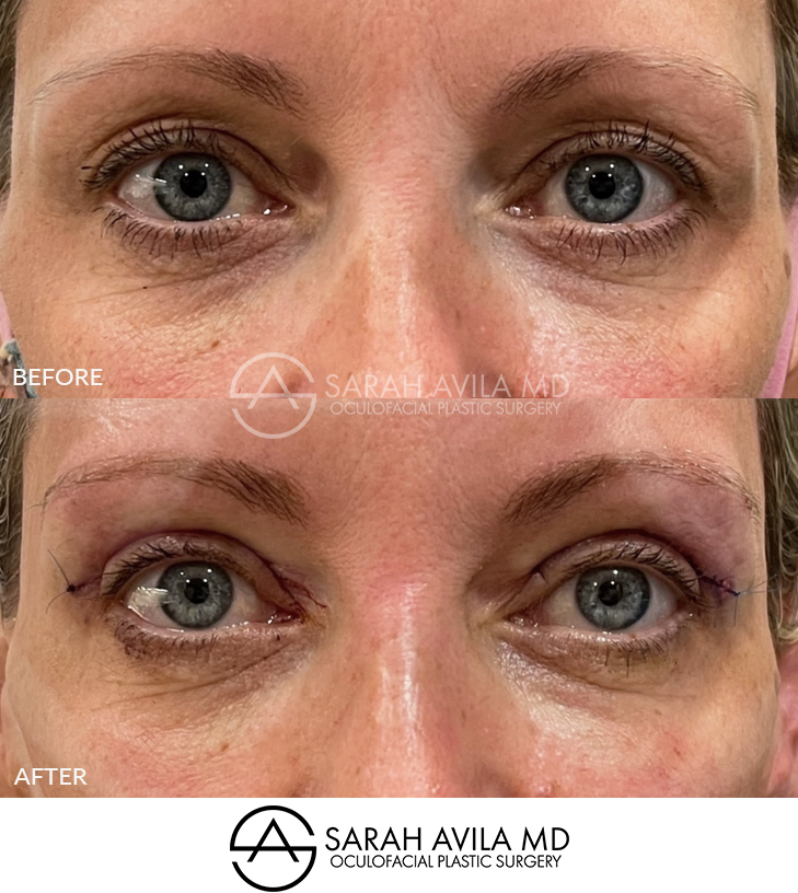 Upper Blepharoplasty Patient 6