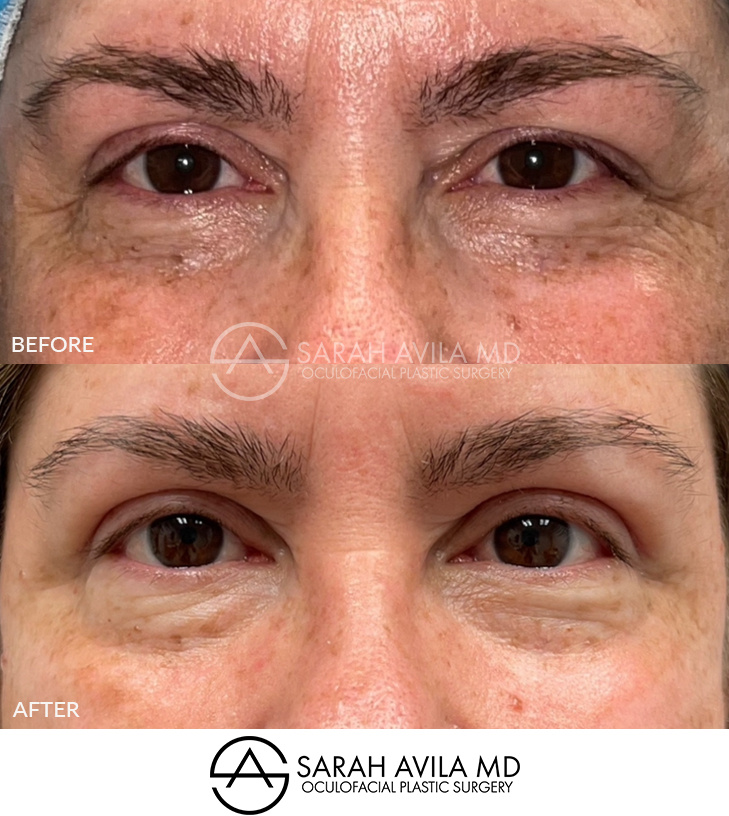 Upper Blepharoplasty Patient 7