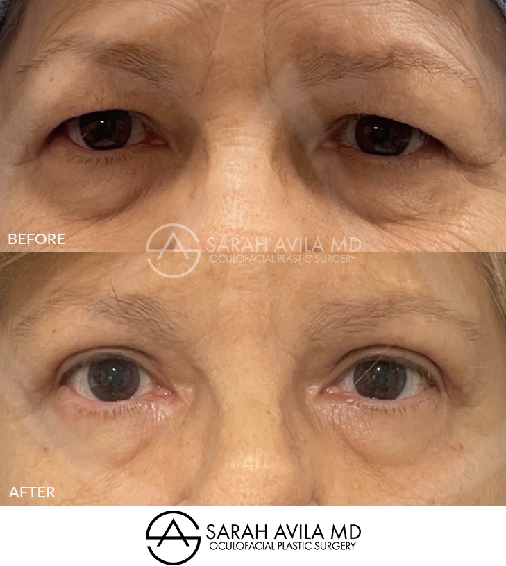 Upper Blepharoplasty Patient 8