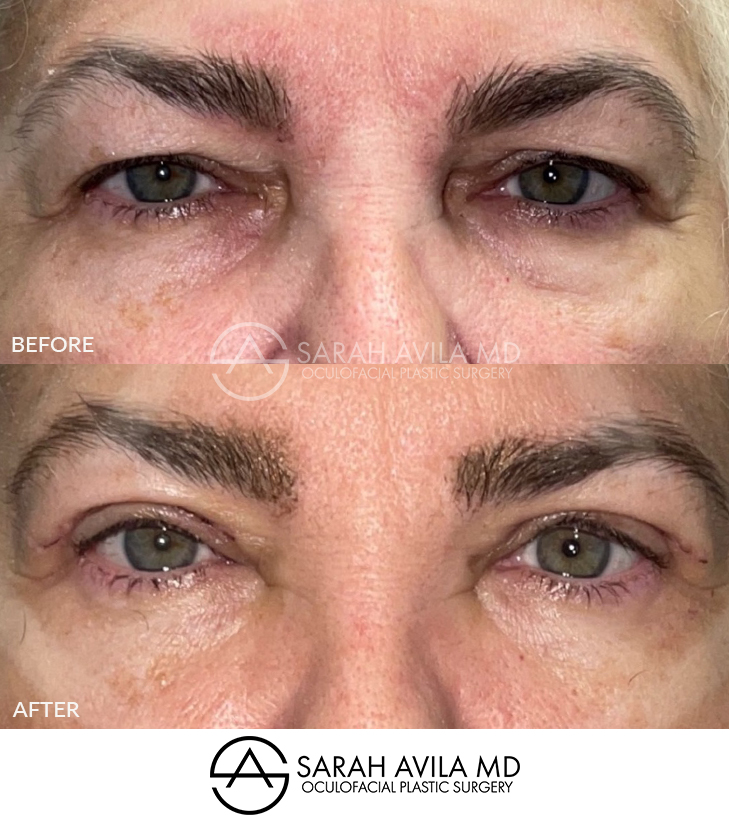 Upper Blepharoplasty Patient 9
