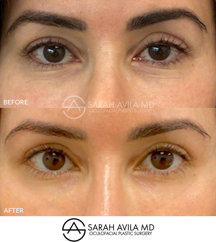 Eyelid Revision Surgery Patient 5