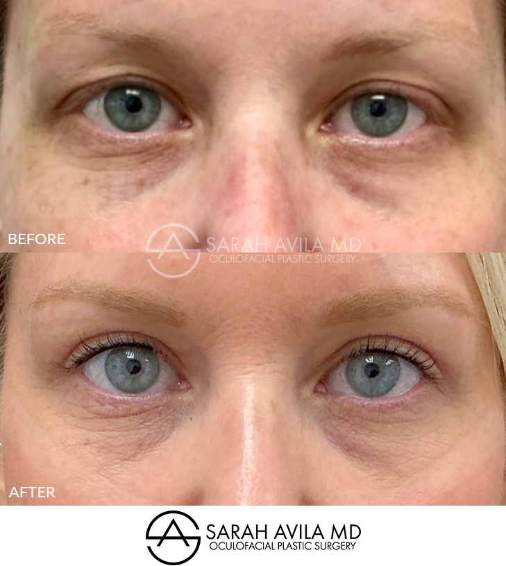 Upper Blepharoplasty Patient 20