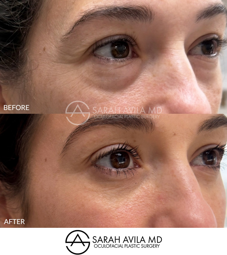Lower Blepharoplasty