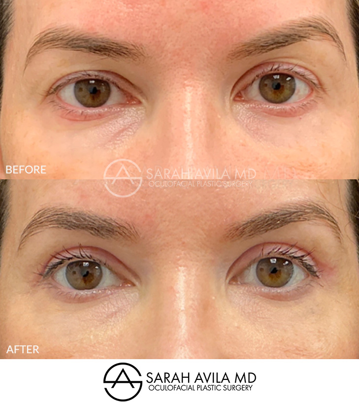 Upper Blepharoplasty