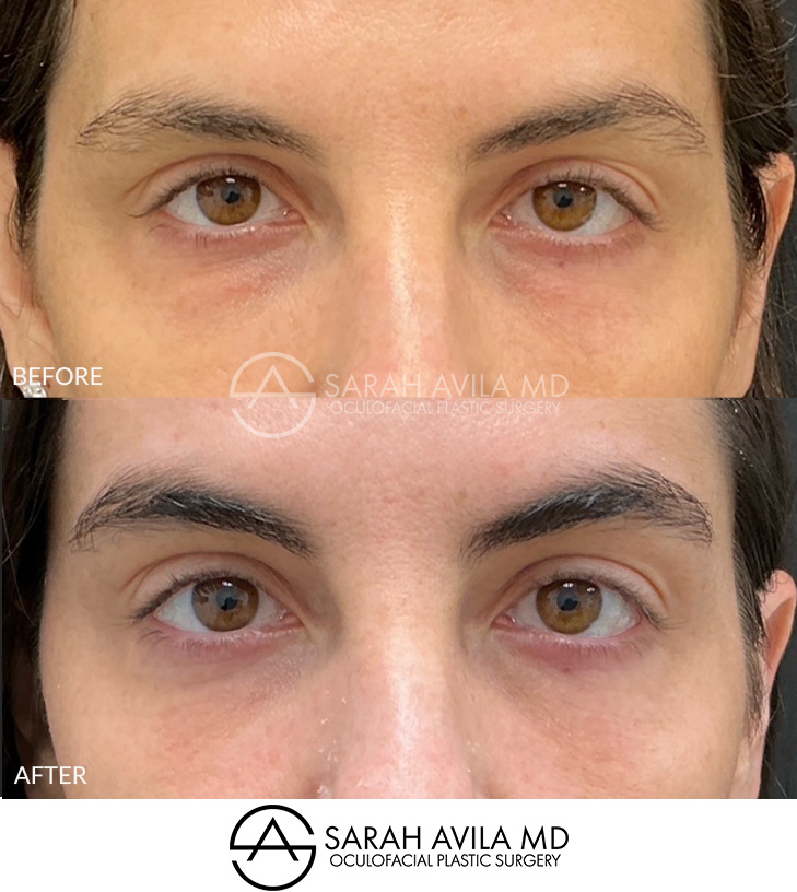 Lower Blepharoplasty