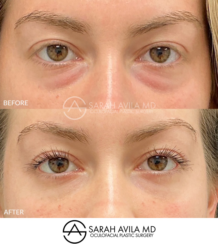 Lower Blepharoplasty