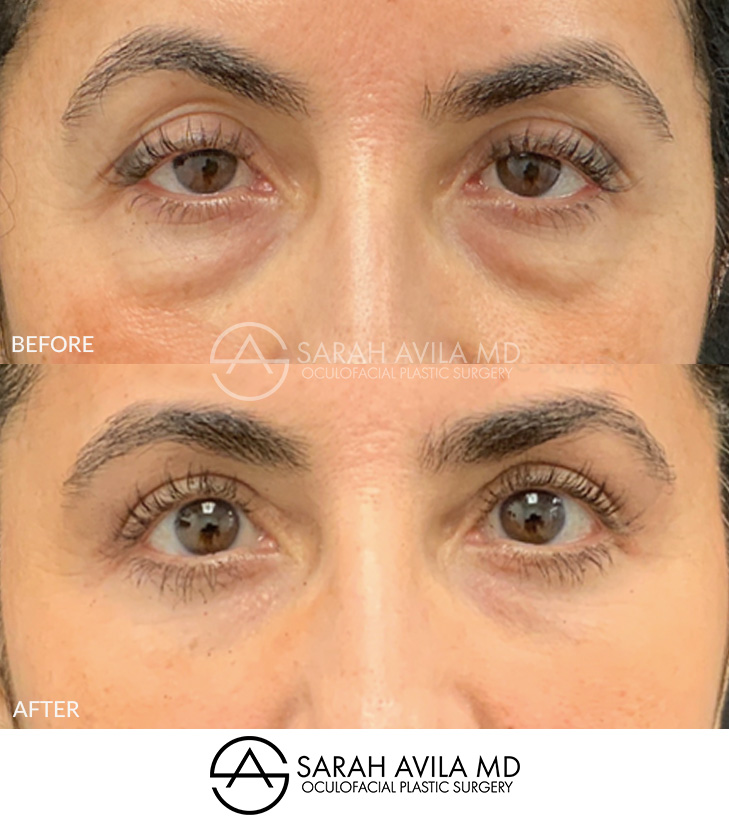 Lower Blepharoplasty