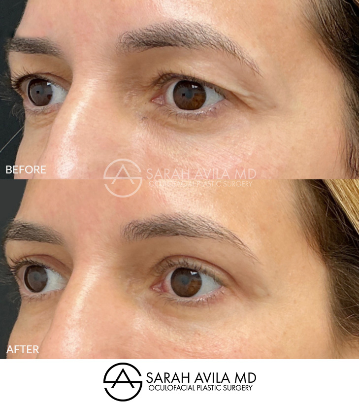 Upper Blepharoplasty