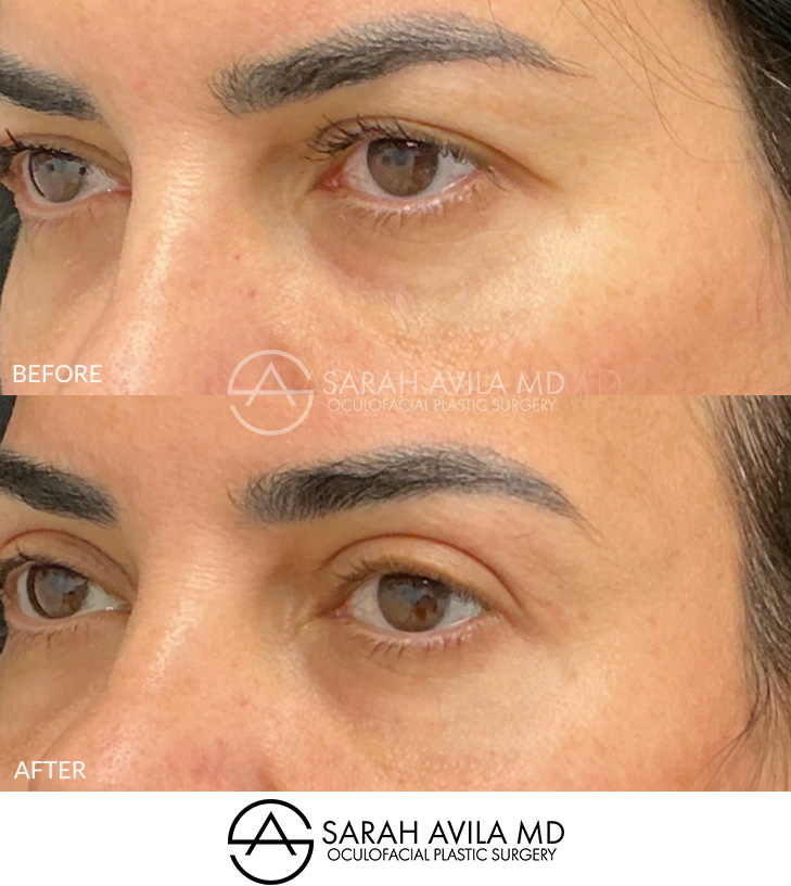 Upper Blepharoplasty